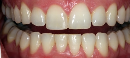 Before and After Invisalign Treatment Milton Keynes