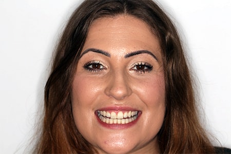 Before and After Invisalign Treatment Milton Keynes