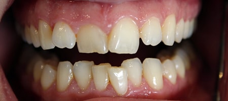 Before and After Invisalign Treatment Milton Keynes
