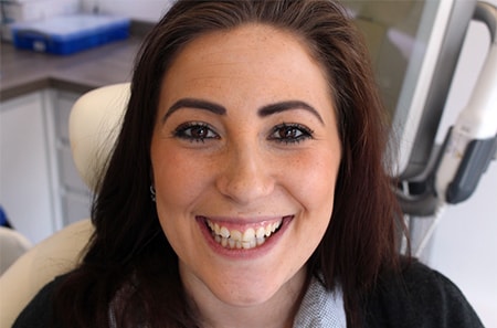 Before and After Invisalign Treatment Milton Keynes