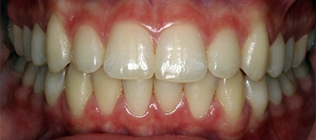 Before and After Invisalign Treatment Milton Keynes