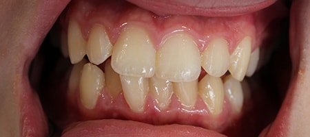 Before and After Invisalign Treatment Milton Keynes