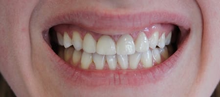Before and After Invisalign Treatment Kingston